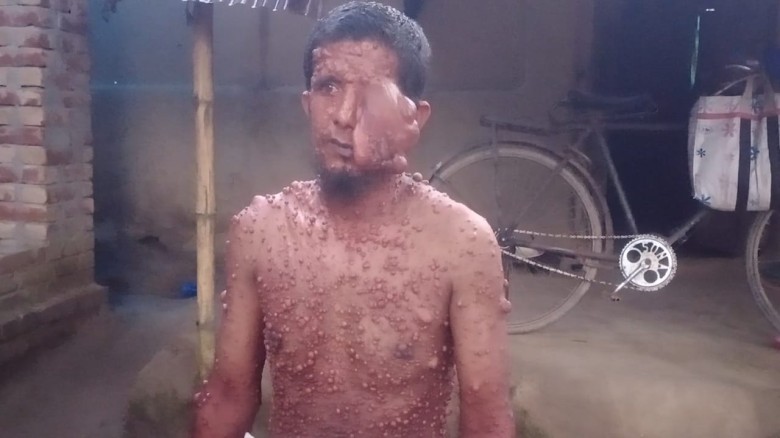 বাগমারা বিরল আক্রান্ত রোগীর জন্য মানবিক সাহায্যের আবেদন
